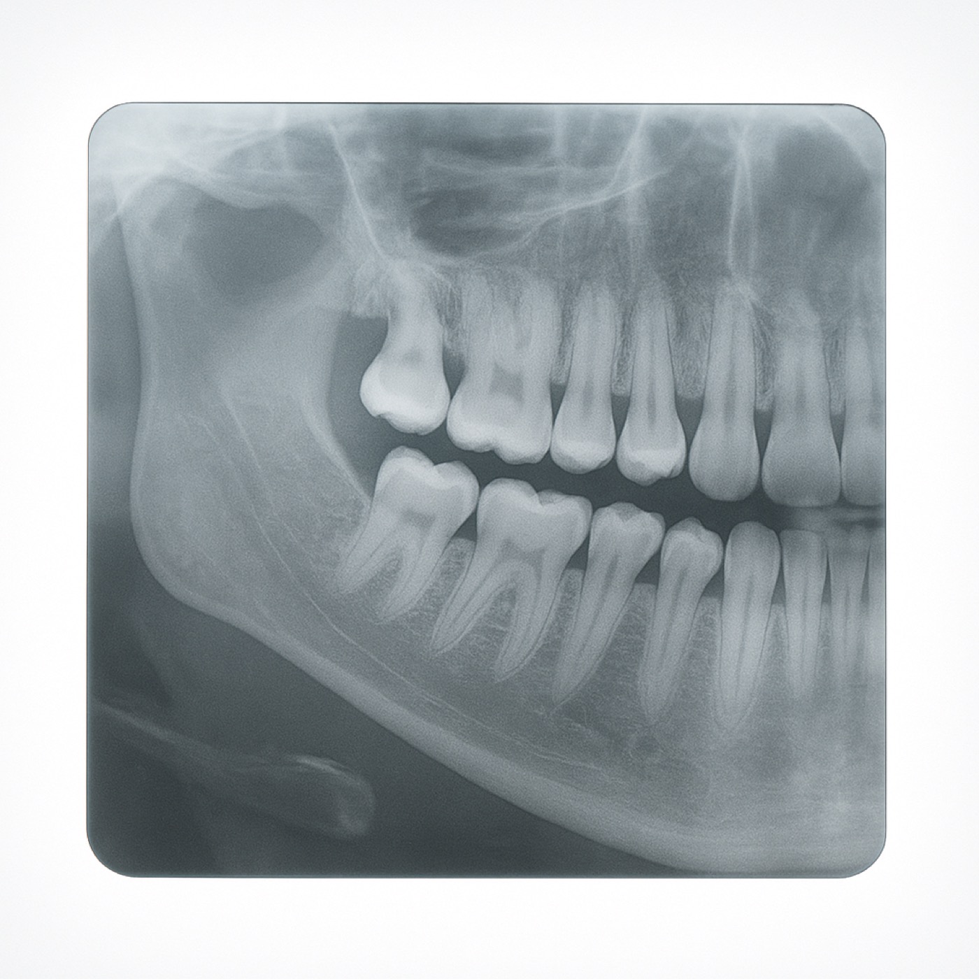 Dentist reviewing wisdom tooth x-ray with patient in Elizabeth NJ